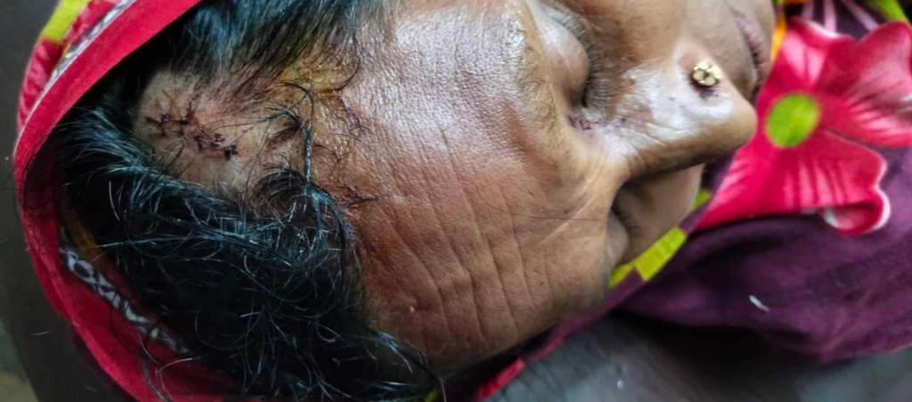 Vrouw met een wond uit Bangladesh